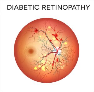diabetic retinopathy Indiana