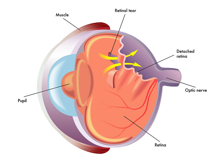 retinal detachment Indiana
