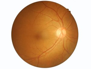 retinal vein occlusions Indiana